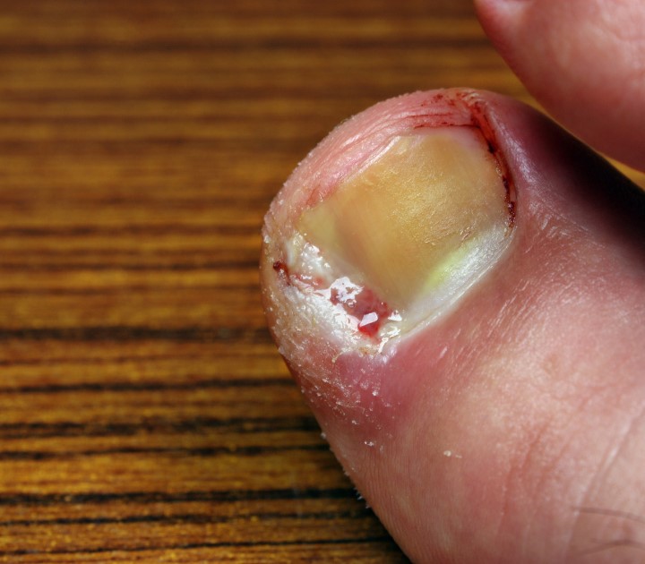 Toenail Infections What Causes Them?